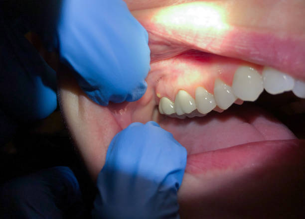Best Emergency Gum Treatment in Krebs, OK
